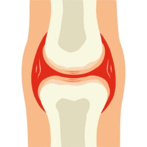Arthritis / Joint